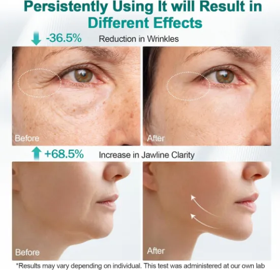 Radiofréquence Visage, 4 EN 1 Appareil Anti Cellulite 40K Lipocavitation Radiofrequence Visage et Corps Amincissants et Raffermissants Appareil Minceur Blanc Argenté